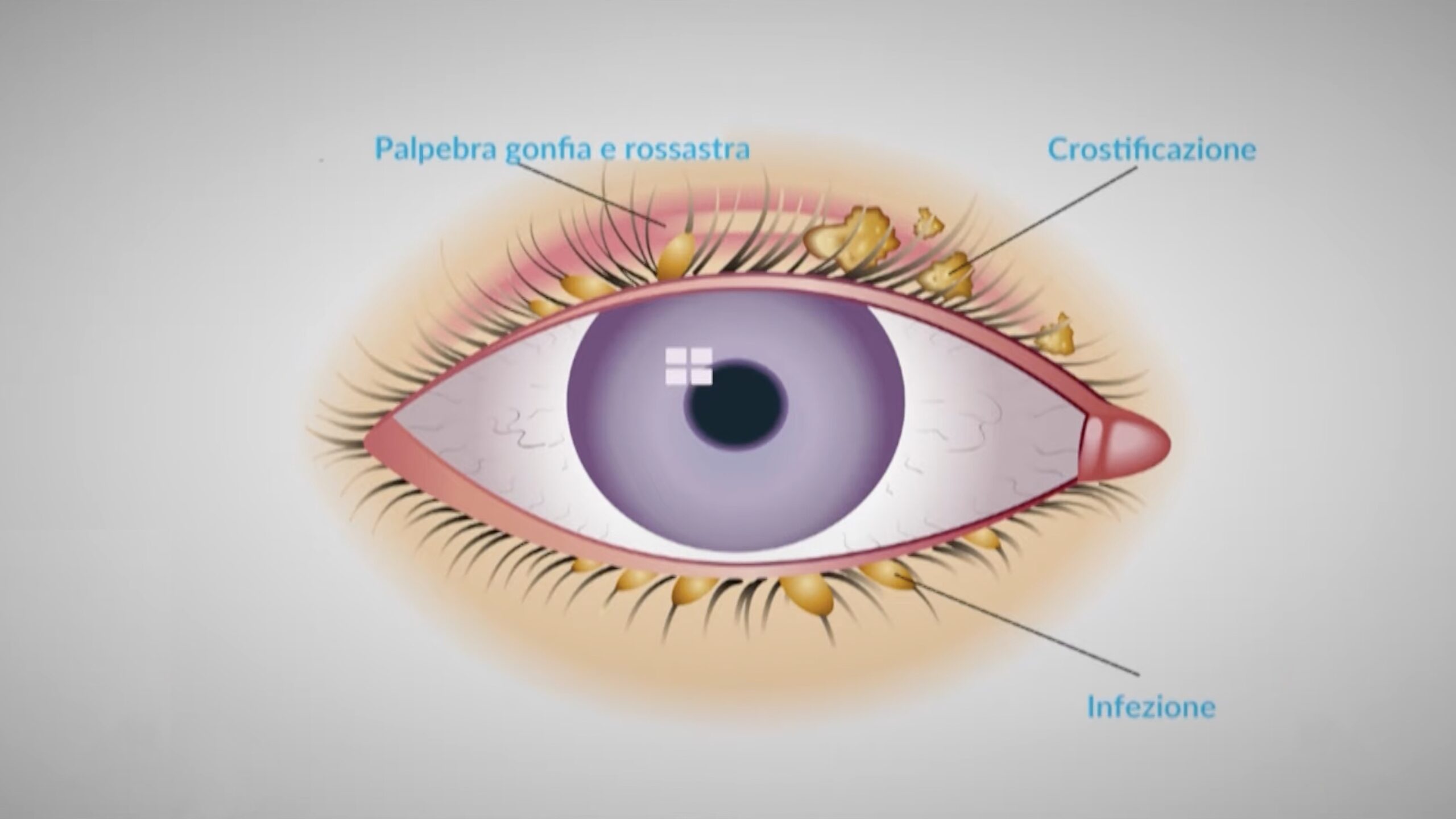 Illustrazione di un occhi con evidenziata la palpebra gonfia e rossastra, la crostificazione e l'infezione